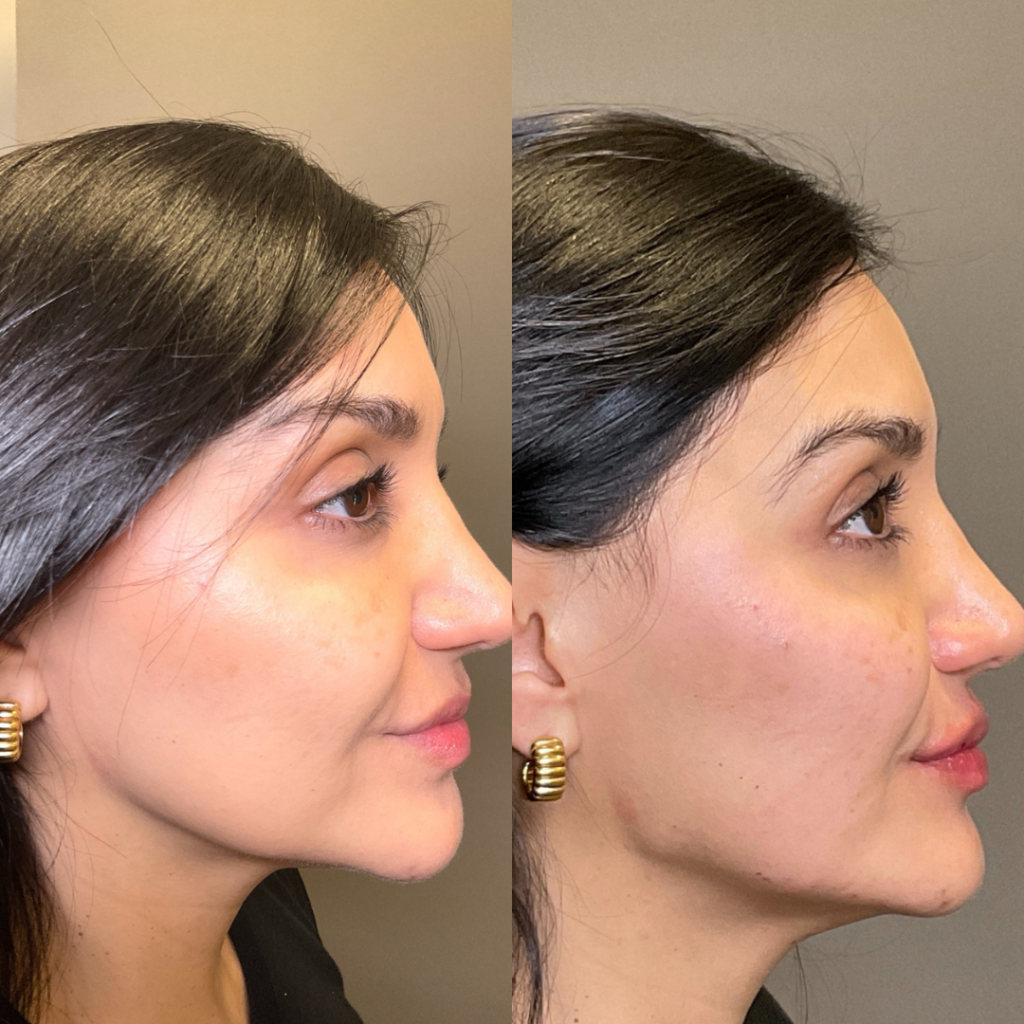 Chemical Peel Mississauga