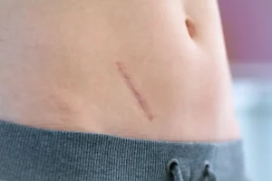 scar removal in mississauga