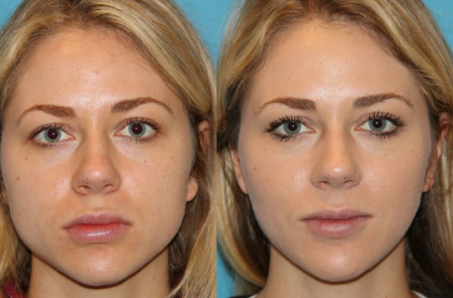Lip Fillers in mississauga
