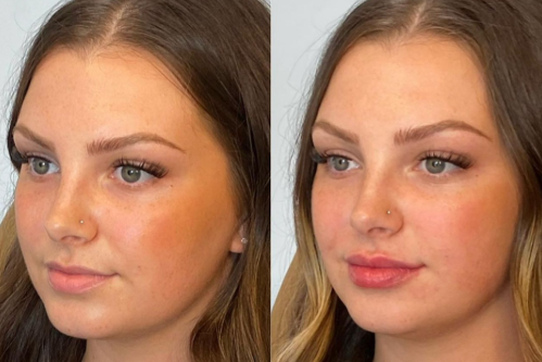 Hair Removal Mississauga