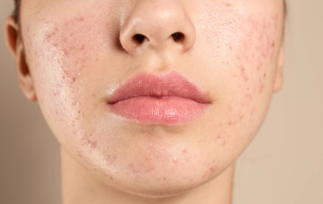 Botox in Mississauga  What to Know Before You Book