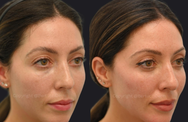 How to Achieve Perfect Jawline Contouring in Mississauga